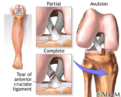 Lesão do LCA - ligamento Cruzado Anterior