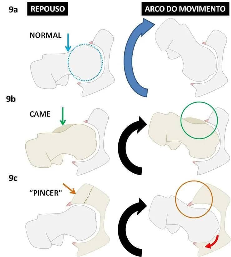 Impacto Femoroacetabular CAM / PINCER