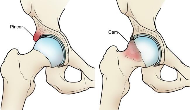 Impacto femoroacetabular - IFA