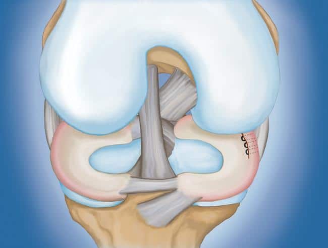 Sutura do Menisco