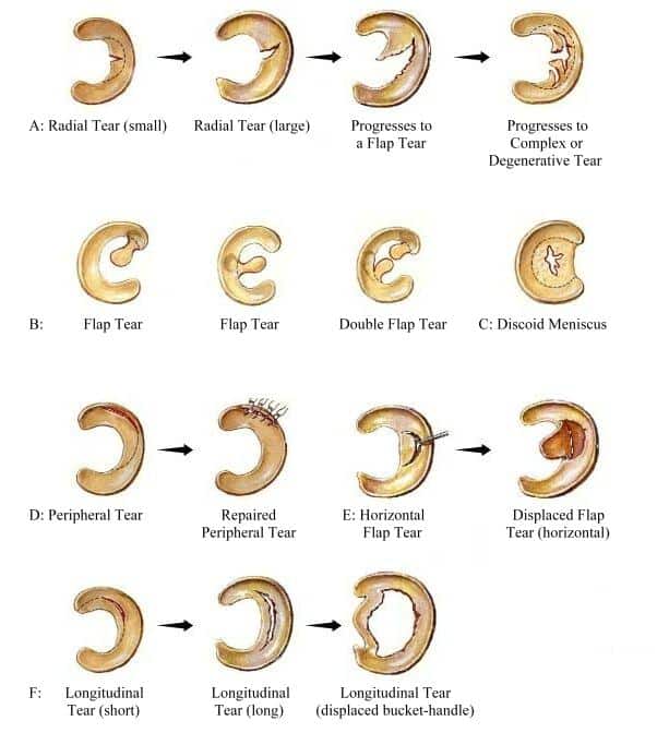 Tipos de Lesão Meniscal