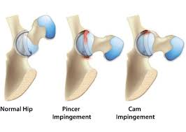 Impacto Femoroacetabular