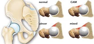 Impacto femoroacetabular IFA