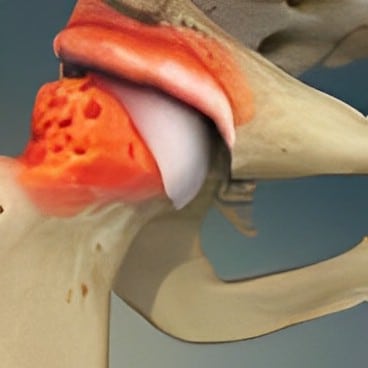 Impacto femoroacetabular