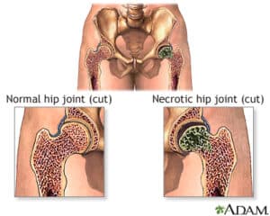 Osteonecrose da cabeça femur