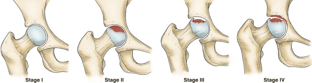 Osteonecrose progressão