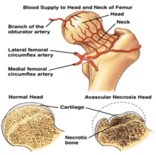 Vascularizacao femur osteonecrose