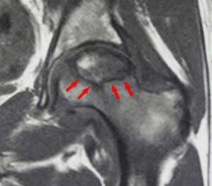 osteonecrose RM 1