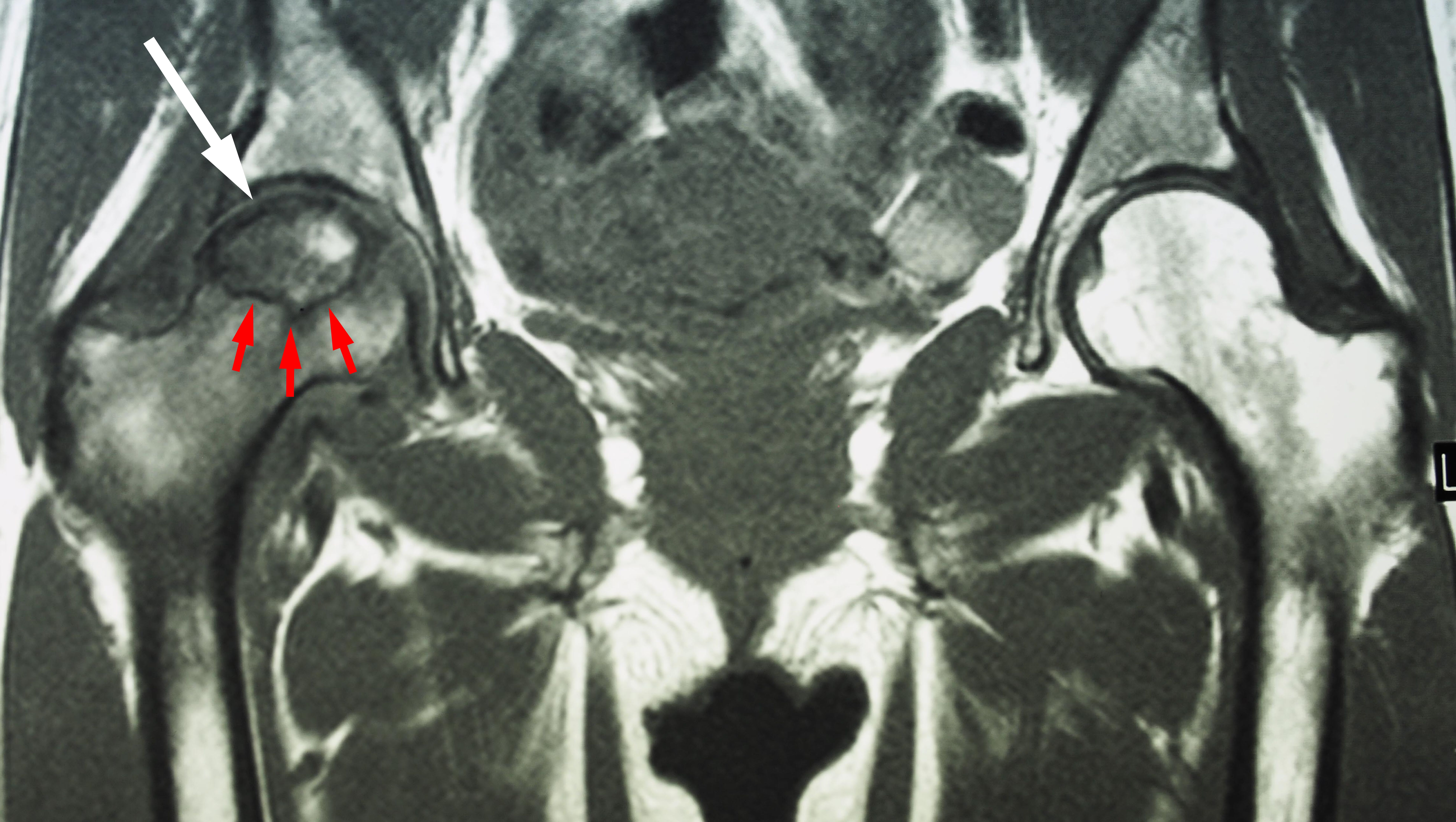 osteonecrose RM