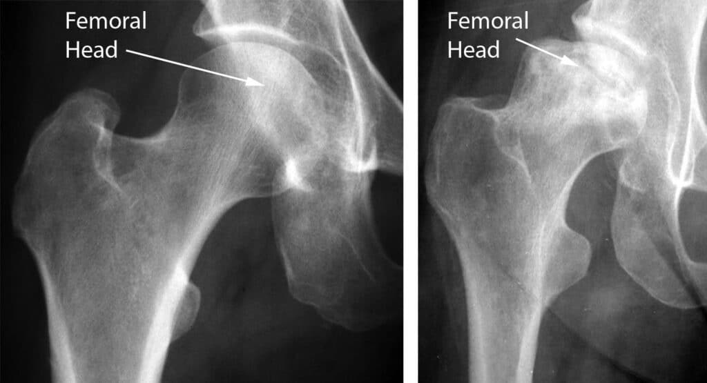 Osteonecrose femur rx