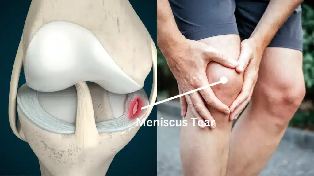 Lesão Meniscal